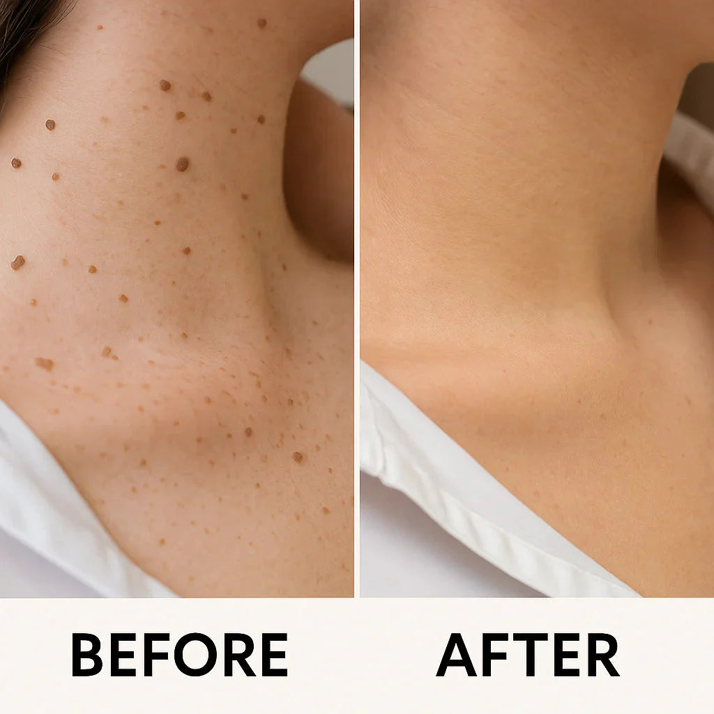 theAsyea ™ Skin Tag & Wart Removal Laser Pen – Safe At-Home Treatment