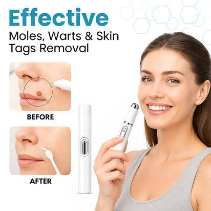 theAsyea ™ Skin Tag & Wart Removal Laser Pen – Safe At-Home Treatment