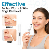 theAsyea ™ Skin Tag & Wart Removal Laser Pen – Safe At-Home Treatment