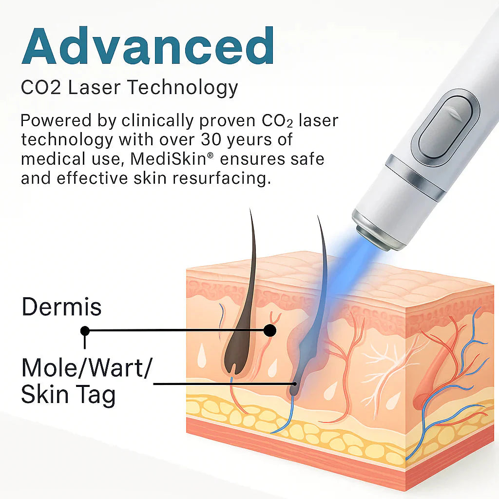 theAsyea ™ Skin Tag & Wart Removal Laser Pen – Safe At-Home Treatment