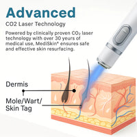 theAsyea ™ Skin Tag & Wart Removal Laser Pen – Safe At-Home Treatment